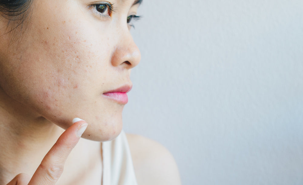 4 Ways To Get Rid Of Hormonal Acne